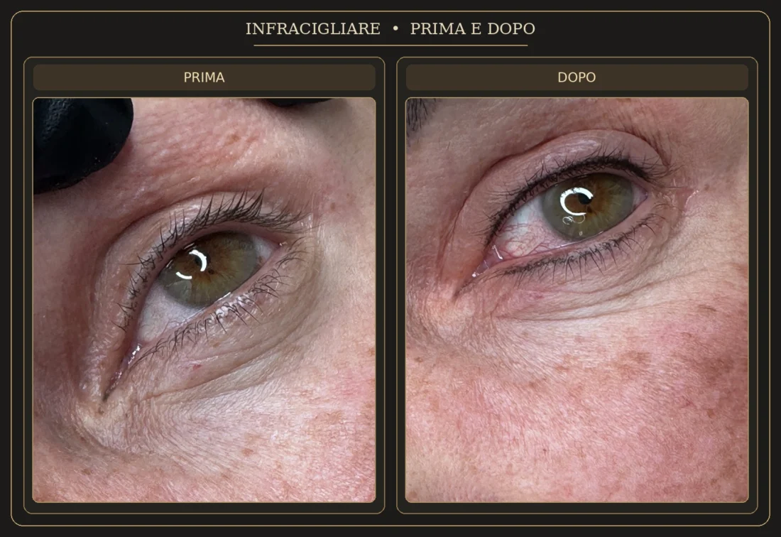 Infracigliare – Prima e Dopo - Elena Parvu