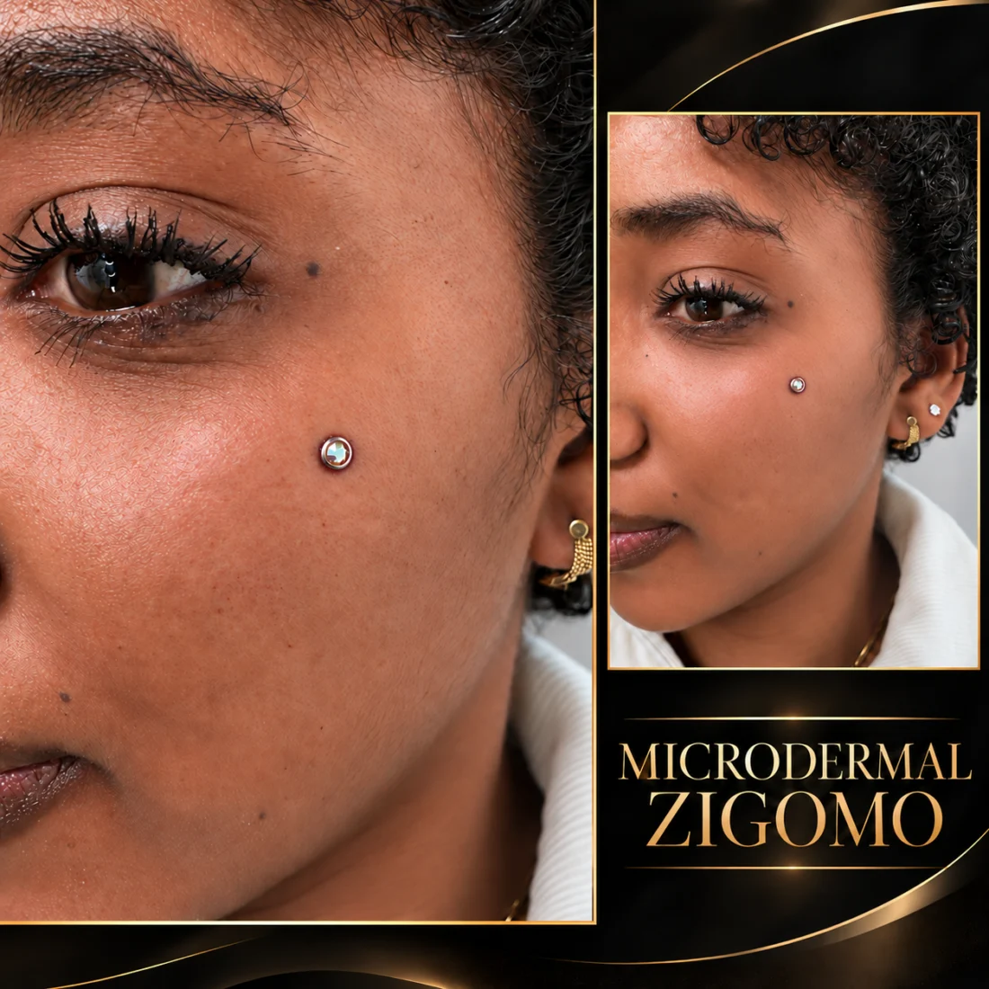 Microdermal Zigomo - Elena Parvu